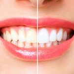 Can Advanced Technology Improve Your Dental Implant Experience?